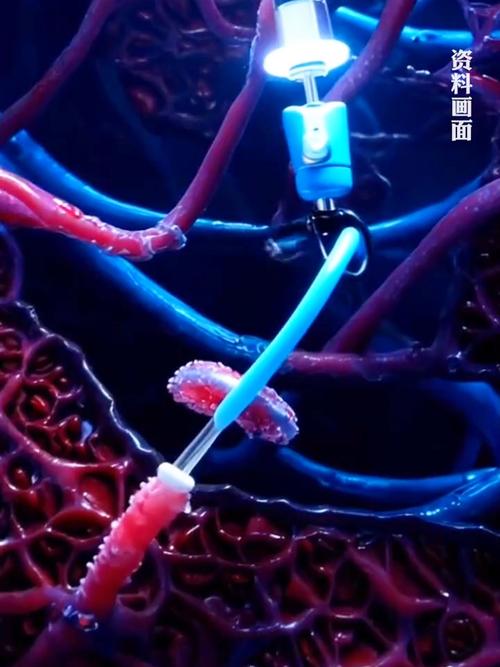 纳米机器人清除血管血栓临床试验